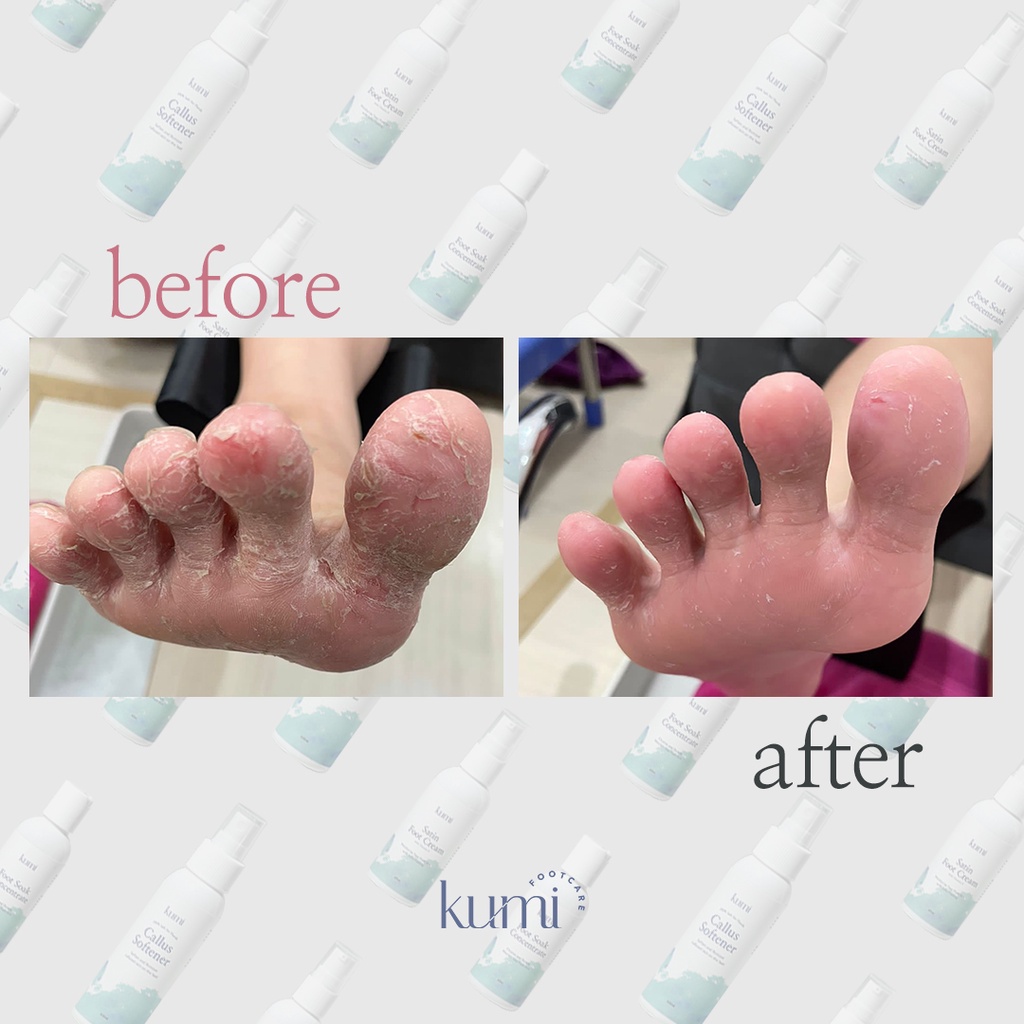 Kumi PEDIDAY Package at Home / Pedicure / Treatment / Callus