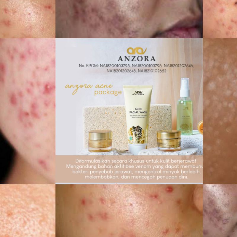 ANZORA SKINCARE - Anzora Skincare Original/Paket Glow/Paket Acne/Paket Removerdarksport (free gifh)