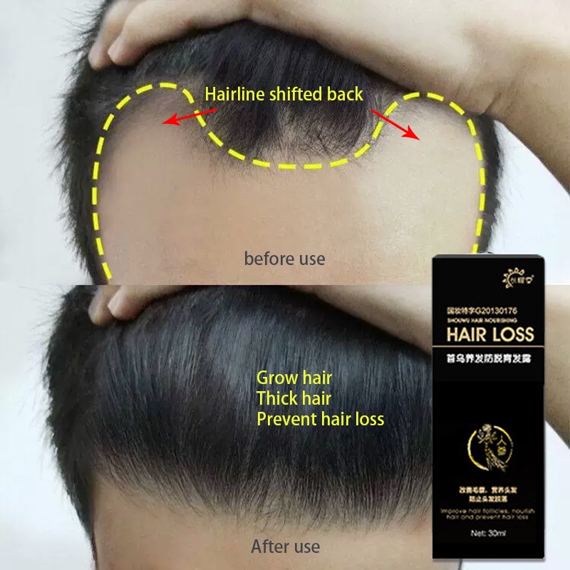 Penumbuh rambut botak Serum rambut rontok 30ml Penumbuh rambut cepat Kontrol minyak Menyuburkan rambut Mencegah Kebotakan