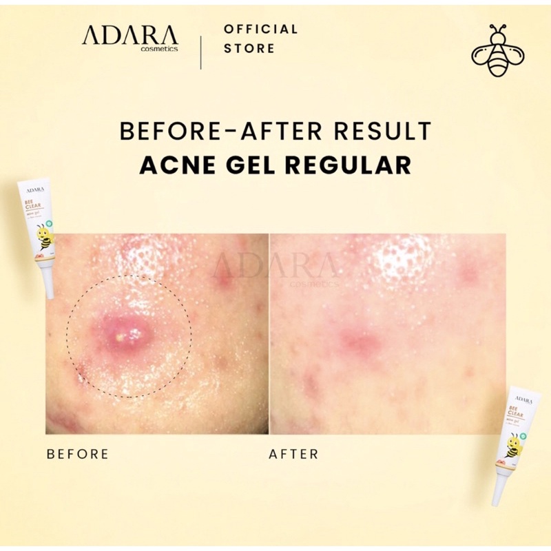 Adara - Bee Clear Acne Gel and Adara Gel Extra Formula