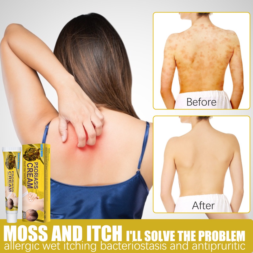 Salep Gatal Itching Cream Salep Kulit Salep Psoriasis Krim Antibakteri Herbal Alami Bintik-Bintik Me