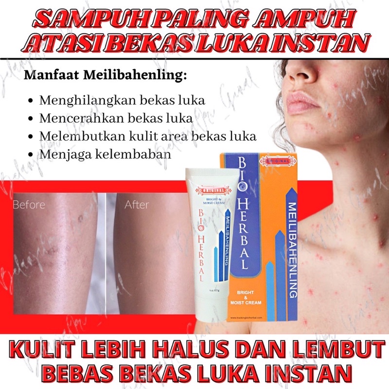Bpom Original Meilibahenling Penghilang Bekas Luka HItam Bopeng Koreng /Jerawat Permanen