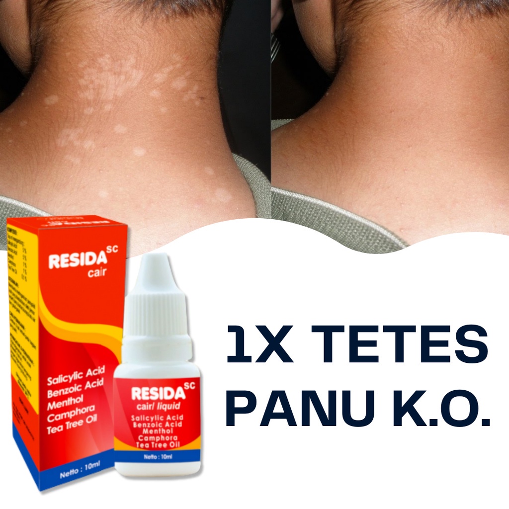 Obat Panu Cair Paling Ampuh 100% Obat Panu Cair Resida Original BPOM Penghilang Gatal Jamur Kadas Ku