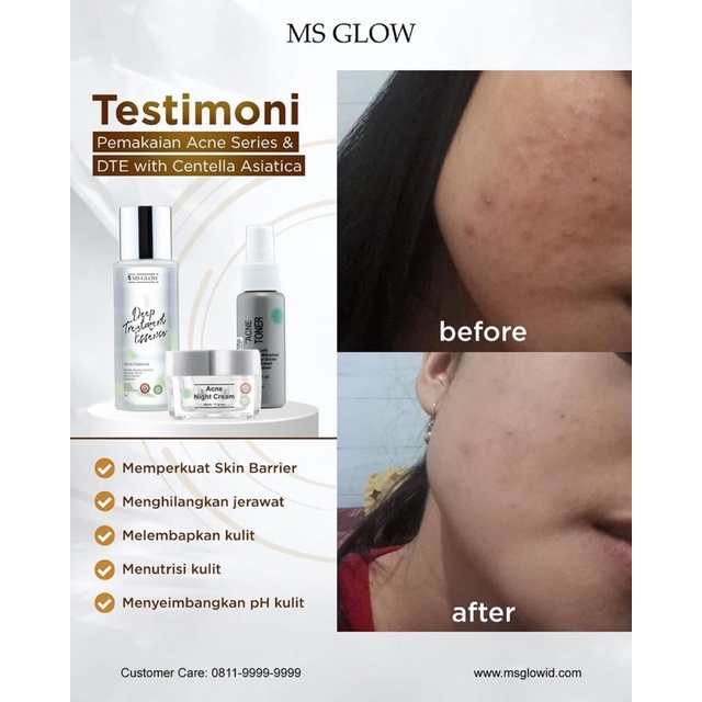 Ms Glow Paket Wajah Acne Original/whitening/luminous/ultimate