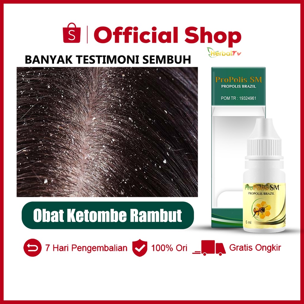 Bosan dengan Ketombe? 12 Rekomendasi Obat yang Efektif untuk Menghilangkannya!