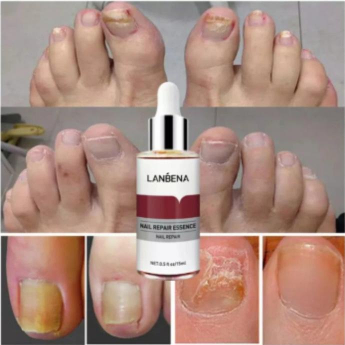 lanbena nail repair original serum kuku rusak