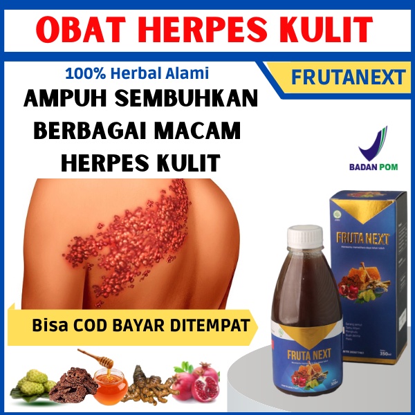 Obat Herpes Kulit, Herpes Kelamin, Herpes Genital, Herpes Zoster, Herpes Bibir, Herpes bayi, Herpes 