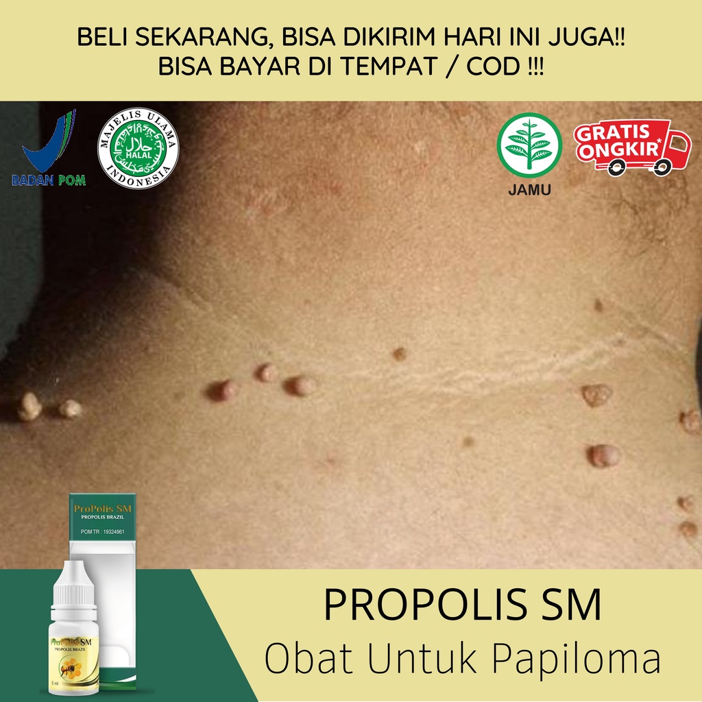 Obat penghilang papiloma di leher dgn Propolis SM - Obat oles untuk papiloma, obat papiloma di wajah