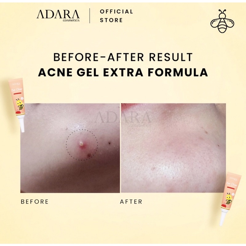 Adara - Bee Clear Acne Gel and Adara Gel Extra Formula