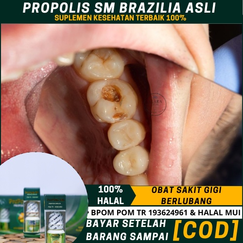 Obat gigi Keropos Dewasa, Penghancur gigi keropos,  Obat Perontok Gigi Berlubang Sampai   Ke Akar, P