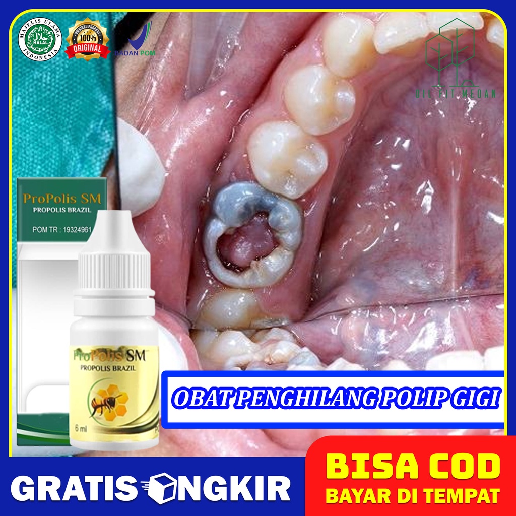 Obat Penghilang Daging Di Lubang Gigi, Daging Jadi, Gusi Tumbuh Di Lubang Gigi, Polip Gigi / Polip G