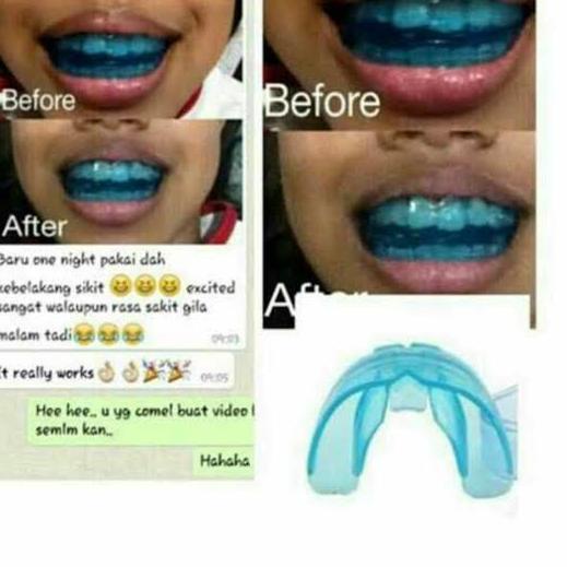 [148] [ BISA COD ] Perapih GIGI Behel teeth trainer alignment (PREMIUM) Dijamin Asli 100%