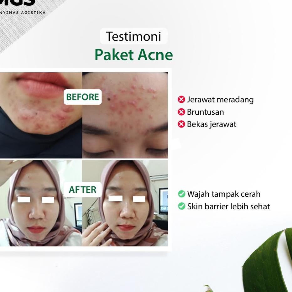Terbaru--cream acne. Paket Acne MGS . penghilang jerawat cream malam totol acne
