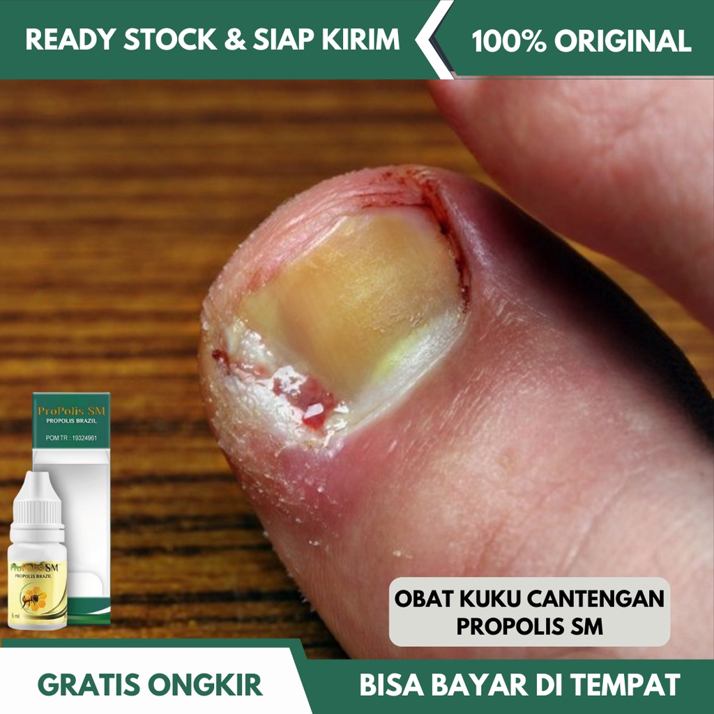 Obat Tetes Cantengan, Obat Cantengan Jempol Kaki Parah, Cantengan Kuku Kaki & Tangan, Obat Oles Kuku