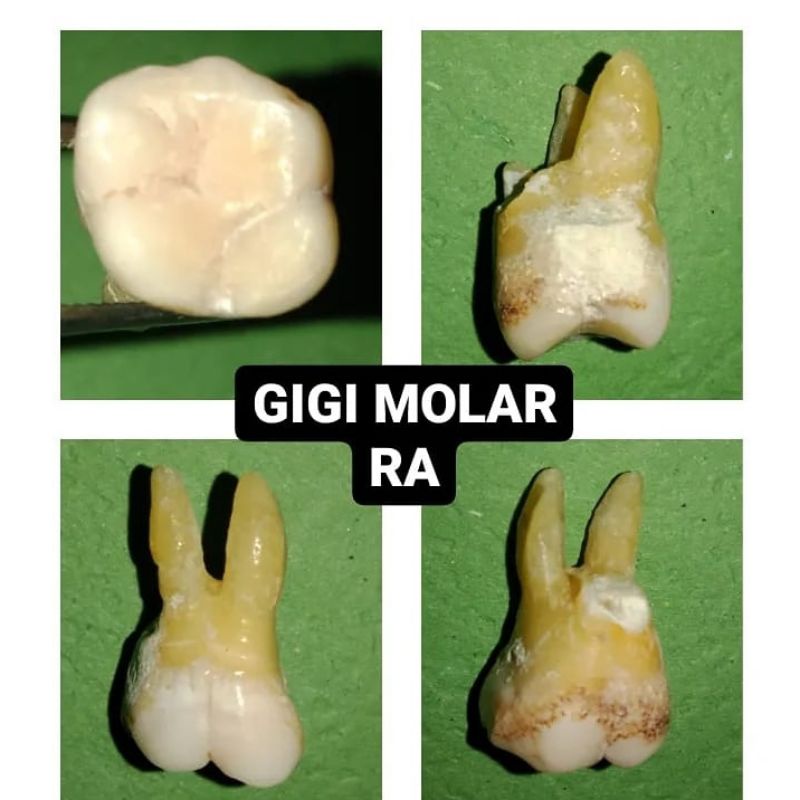 gigi praktikum molar rahang atas/gigi molar/gigi molar atas