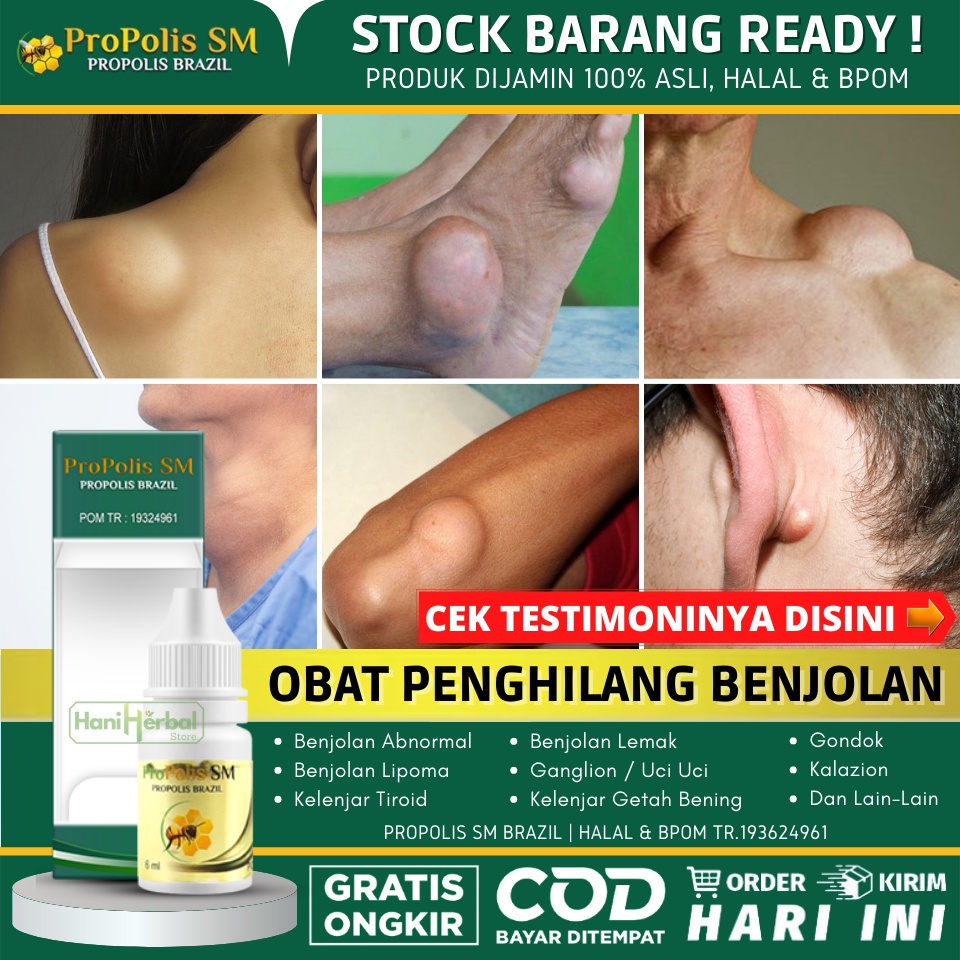 Obat Kista Ateroma, Obat Penghilang Benjolan Kista Ateroma, Salep Benjolan Abnormal di Tubuh, Obat O