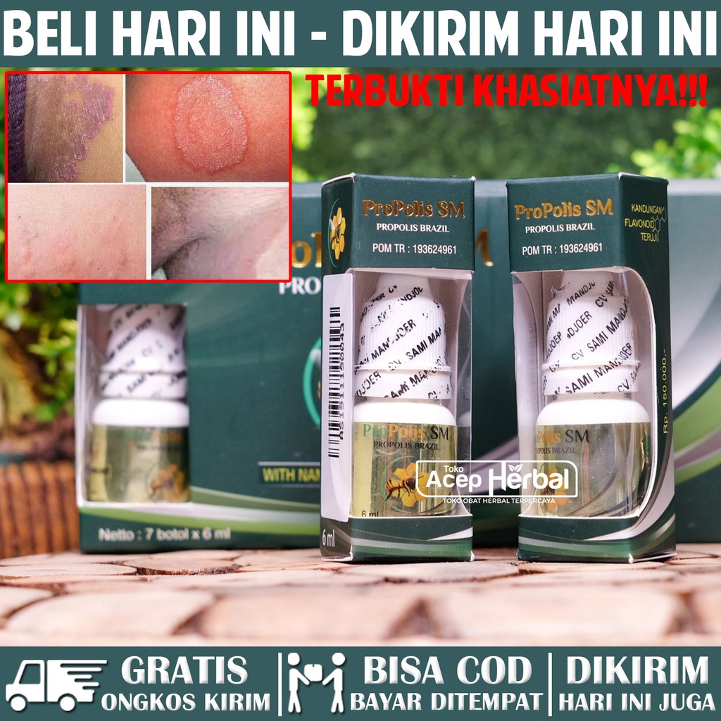 Obat Spesialis Gatal Selangkangan Selengkangan Gatal Karena Jamur Babak - Propolis SM Original