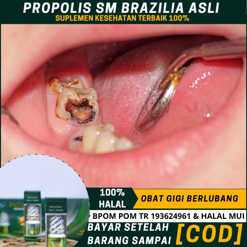 Obat Gigi Berlubang, Gigi Bolong, Obat Sakit Gigi Berlubang Dan Gusi Bengkak, Obat   Penghancur Gigi