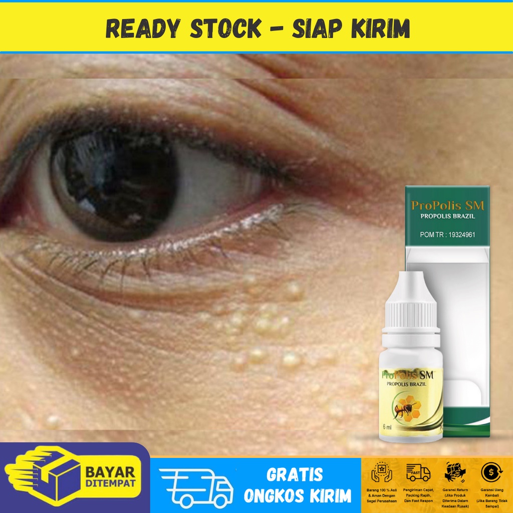 Obat Milia Beruntusan di Wajah, Obat Milia diarea Mata, Obat Milia di Bawah Mata, Obat Milia di Deka