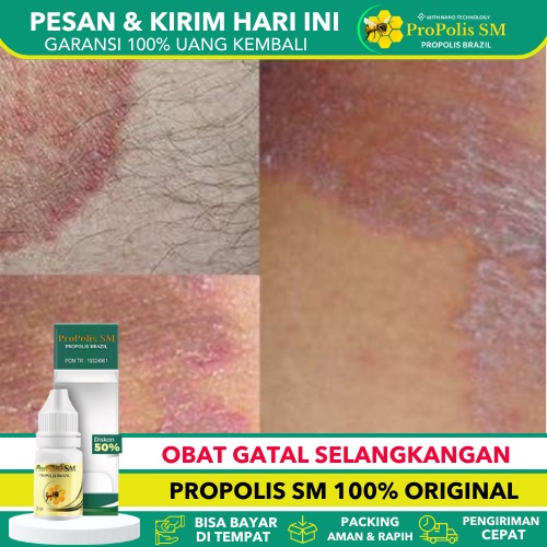 Jual Obat Gatal Selangkangan Pria Dan Wanita Obat Jamur Selangkangan