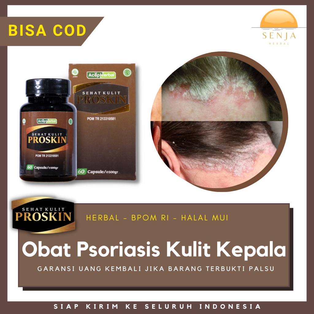 Obat Psoriasis Kepala Ketombe Parah Berkerak Tuntaskan Dengan Kapsul Proskin | REAL TESTI