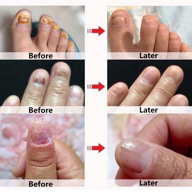 [100% Asli Ampuh] Obat kuku perawatan kuku rusak jamur kuku obat infeksi kuku penghilang jamur kuku 