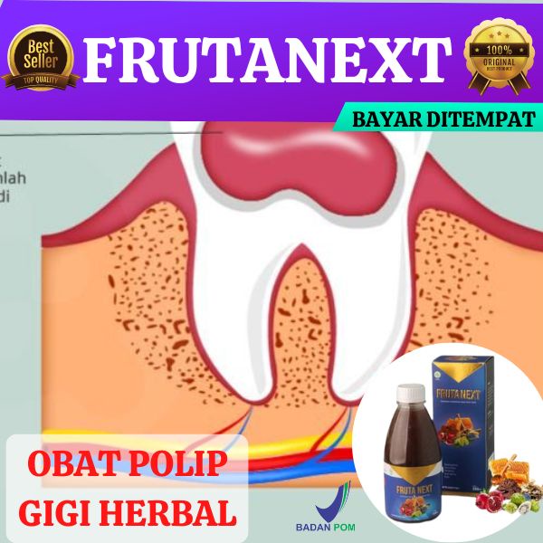 FRUTANEXT Obat Polip Gigi Herbal Polip Pulpa Benjolan Lunak Di Gigi Berlubang