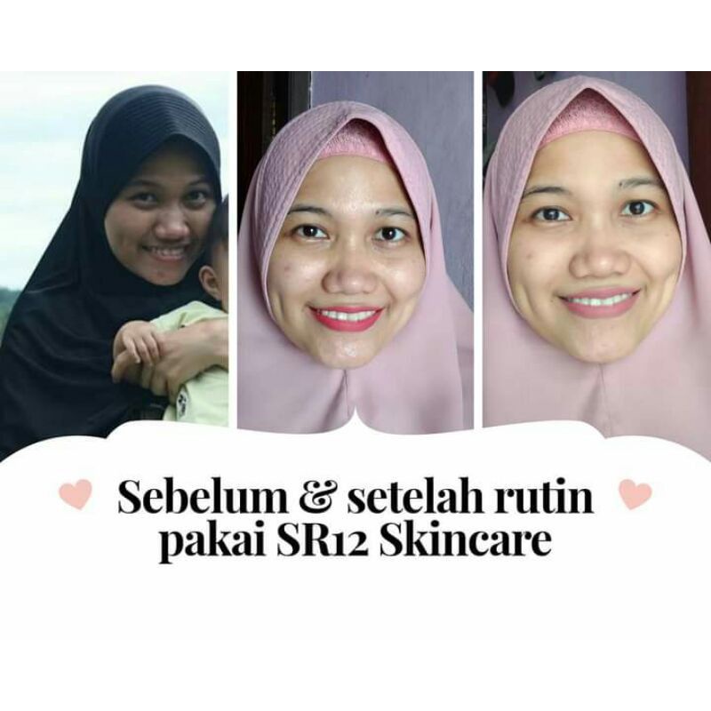 (COD)SPOT ESSENCE SR12 - MENGHILANGKAN FLEK HITAM DIWAJAH - KRIM WAJAH/ KRIM PEMUTIH BPOM/ PENGHILANG FLEK WAJAH/ WHITENING CREAM