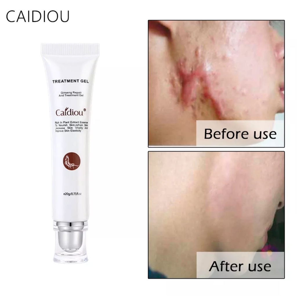 ORI 100% CAIDIOU Gel Ginseng Perbaikan Jerawat Bekas Luka Tersiram Air Panas Operasi Bekas Luka Gigi