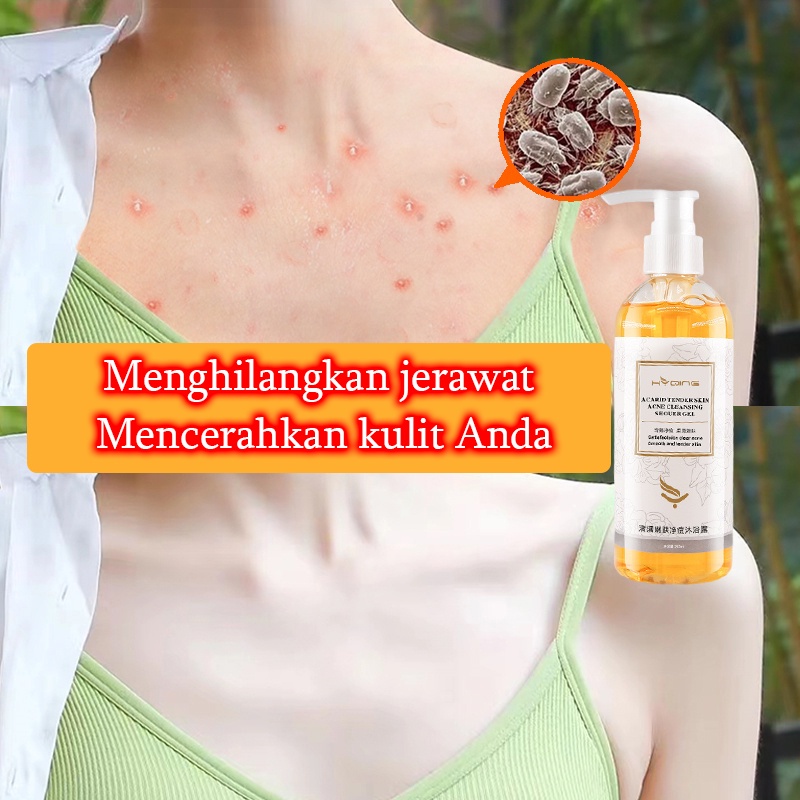 Gel mandi Sabun mandi jerawat cair pemutih badan Acne body wash Whitening body wash Menghilangkan tungau dan jerawat Pemutih kulit Banyak nutrisi Pembersihan lembut Mengangkat kotoran kulit dan sel kulit mati