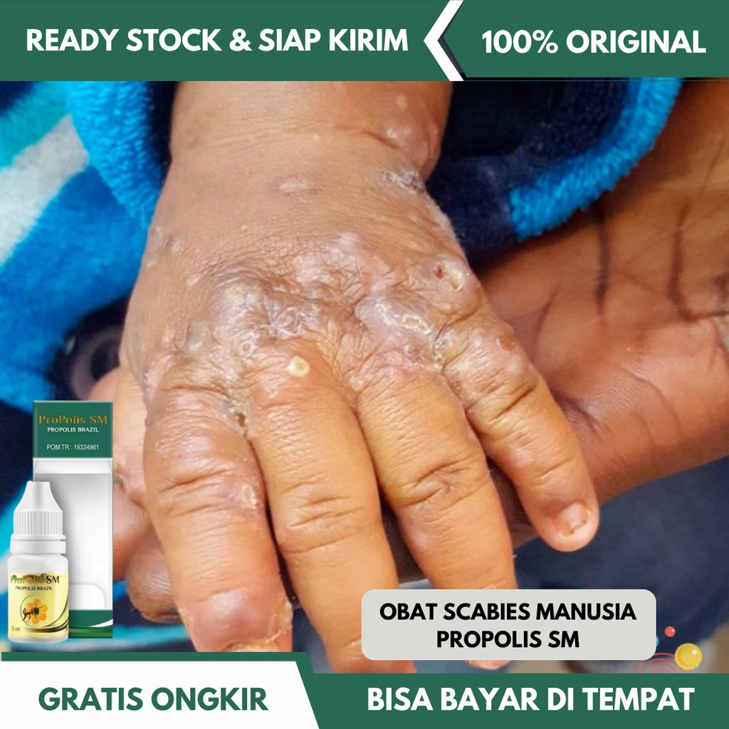 Obat Oles Scabies Manusia, Obat Pembasmi Kutu Sekabies Kudis Gudik Budug, Obat Gatal Karena Tungau, 