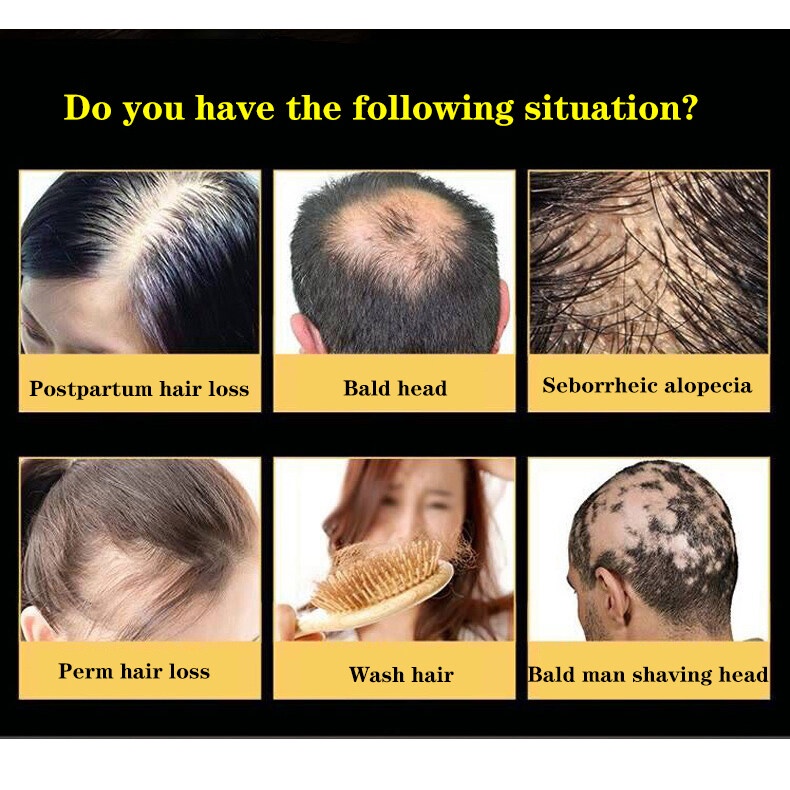 Penumbuh rambut botak Serum rambut rontok 30ml Penumbuh rambut cepat Kontrol minyak Menyuburkan rambut Mencegah Kebotakan-1