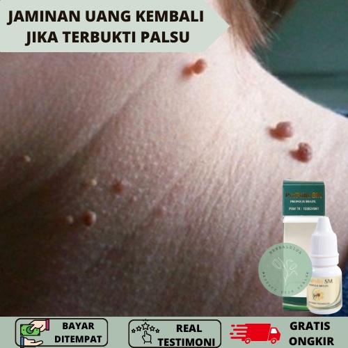 Obat Papiloma Di Leher, Obat perontok papiloma, Obat Perontok Kutil di leher, Obat Penghilang Kutil 