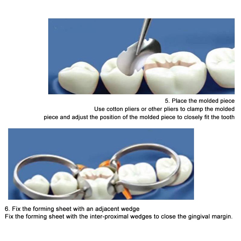 Gigi Metal Ginjal Band Wedges Set/Dental Sectional Contoured Matrix/Dental Saddle Matrix Spring Clip Sectional