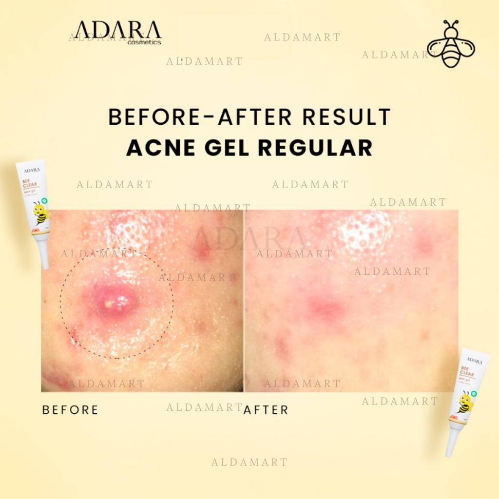 ADARA Obat Totol Jerawat Bee Clear Acne Gel / Bee Clear Extra Formula