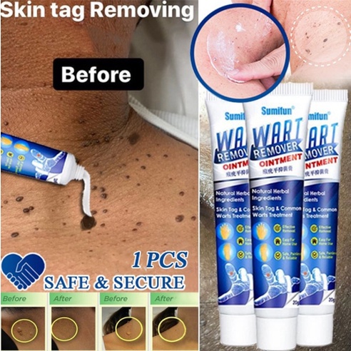 Sumifun Wart Remover &amp; Skin Tag Remover Ointment -Salep Obat Penghilang Kutil Dan Obat Penghilang Tahi Lalat - 20gr