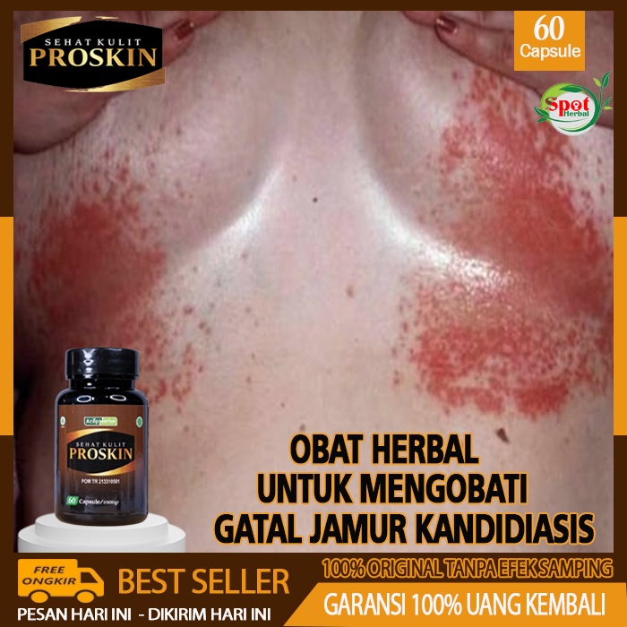 Obat Alami Gatal Kulit Akibat Jamur Candidiasis, Obat Herbal Atasi Infeksi Jamur Kandidiasis Pada Ku