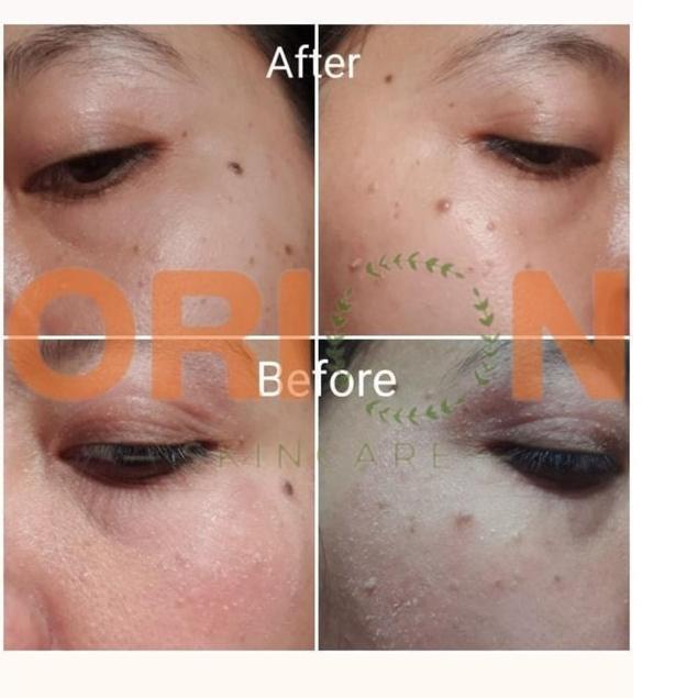 GRATIS ONGKIR✅"TERBUKTI" ORION Moist Lotion REAL CERAMIDE FOR + Eczema/Eksim/Dermatitis + Kulit Keri