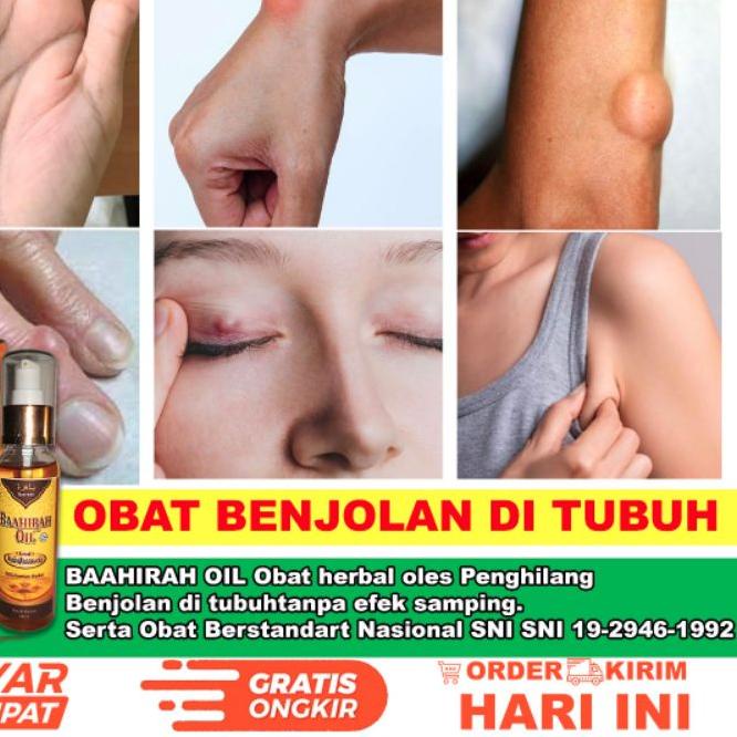 Diskon✔️( MINYAK OLES BENJOLAN PALING MUJARAP ) obat segalah benjolan ditubuh - benjolan - limpoma -