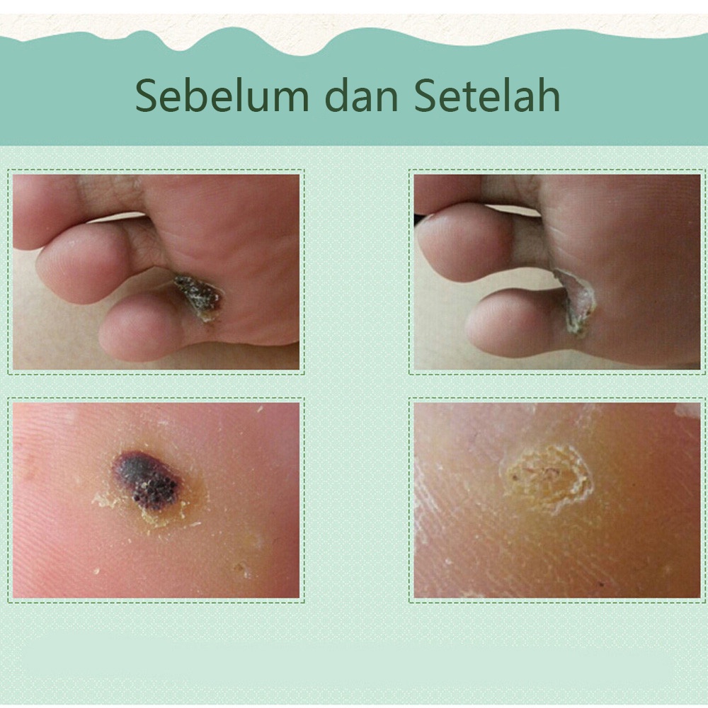 Cairan Obat Untuk Kutil Salep Untuk Kapalan Kaki Cairan Anti Kutil Tangan Dan Kaki Menghilangkan Kutil &amp; Skin Tag Cairan Antibakteri Obat Kutil 10ml Kapalan Di Tangan Dan Kaki Krim Antibakteri Penghilang Tahi Lalat