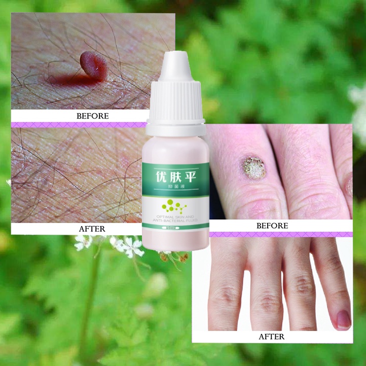 Obat mata ikan penghilang kutil Obat kutil kelamin 10ml Obat cair antibakteri kutil tangan dan kaki Menghilangkan Mata Ikan Di Kaki 100% Herbal Alami