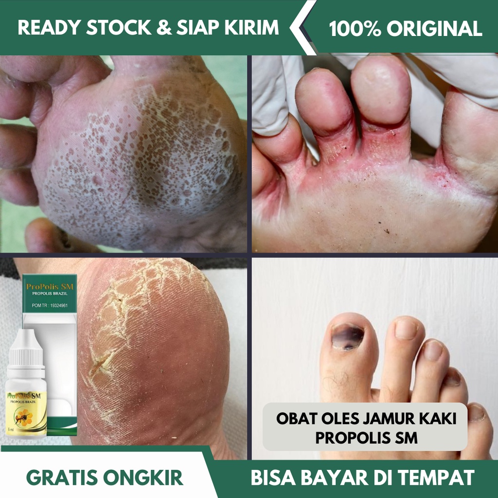 Obat Jamur Kaki, Infeksi Jamur pada Kulit Kaki, Tinea Pedis, Kuku Berjamur dan Rusak, Jempol Kaki Ca