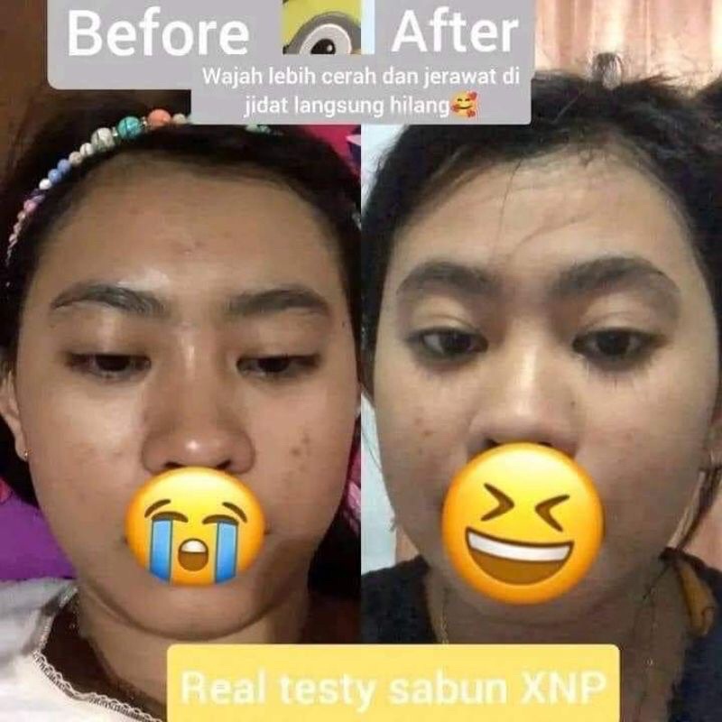 Sabun X Natural Pro cocok semua kulit,glowing,jerawat,flekhitam,komedo, dan menyehatkan kulit