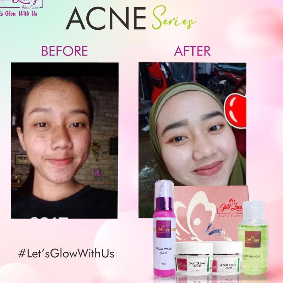 Penawaran Terbaik--paket glow luxury ACNE WHITENING BPOM ORIGINAL/cream jerawat/cream farmasi/cream 