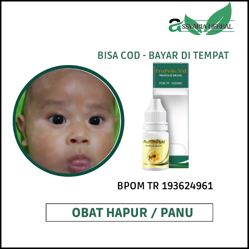 Obat Hapur Panu Cair Kulit Panu Gatal Panu Jamur Kulit Panu Propolis Sm