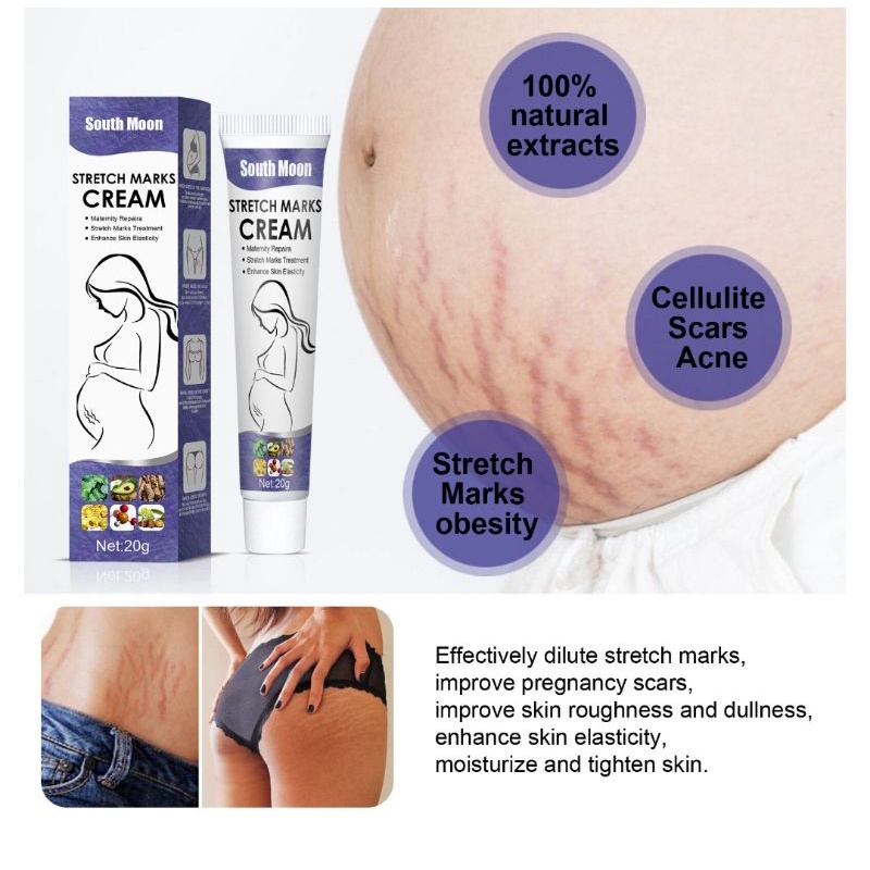 Cream Salep Stretchmark Paling Ampuh South Moon Stretch Mark Treatment  Krim Stretch mark Treatment - South moon