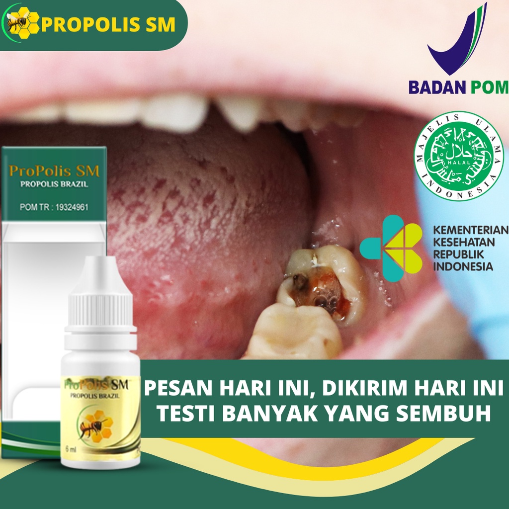 Obat Gigi Bolong, Obat Gigi Goyang, Obat Akar Gigi, Obat Penghancur Gigi Berlubang Gigi Obat Sakit G