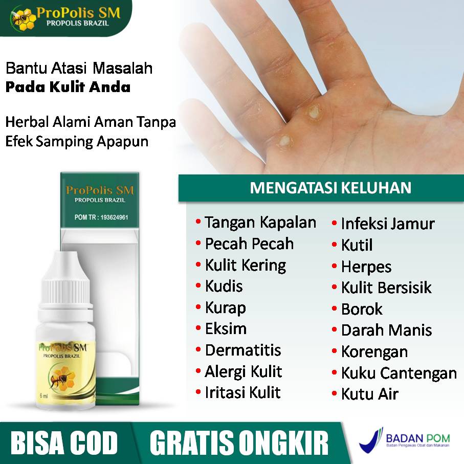 Obat Tangan Kapalan, Kering, Pecah Pecah, Dermatitis Seboroik, Kudis, Kurap, Kulit Kering, Bersisik,