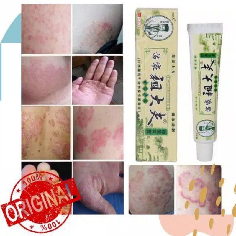 Zudaifu Salep Gatal Original 100% Asli Obat Salep Jamur Gatal Kulit Paling Ampuh Kudis Kurap Gatal P