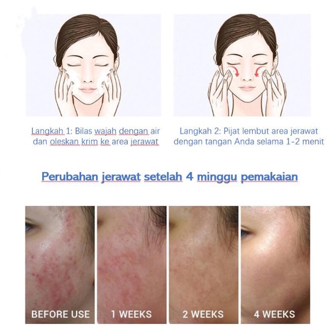 【ORIGINAL】Krim Jerawat Pembersih Penghilang Jerawat Cream Jerawat Acne Cream 30g Membersihkan Kulit Secara Mendalam Menghilangkan Melanin Jerawat dan Bekas Jerawat Perawatan Kulit Unisex